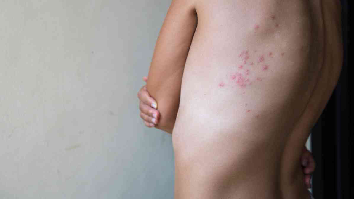 2. Bed Bug Bites Pictures