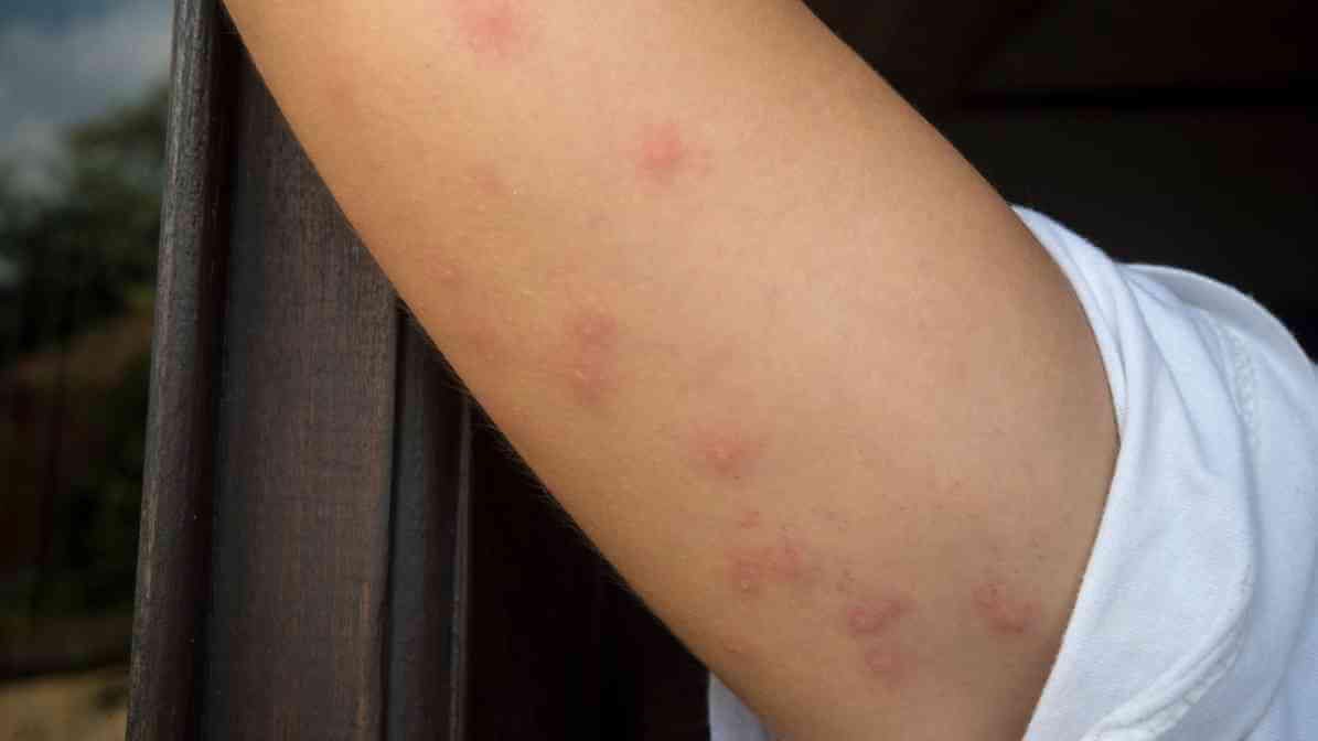 4. Bed Bug Bites Pictures