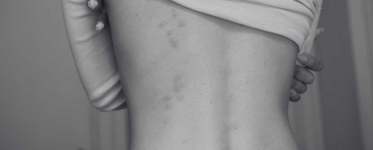 Learn More About Bed Bug Bite - Blog