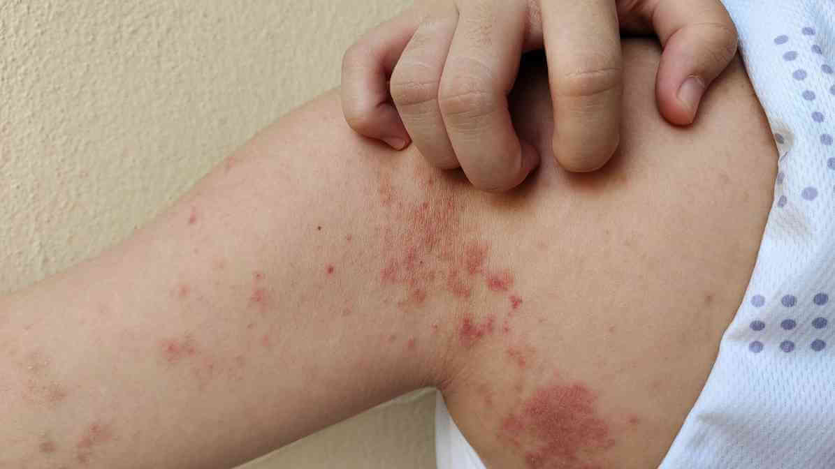 Charlie Ant Bite Symptoms