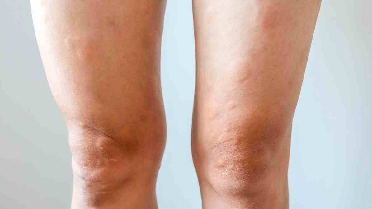 Charlie Bite Treatment