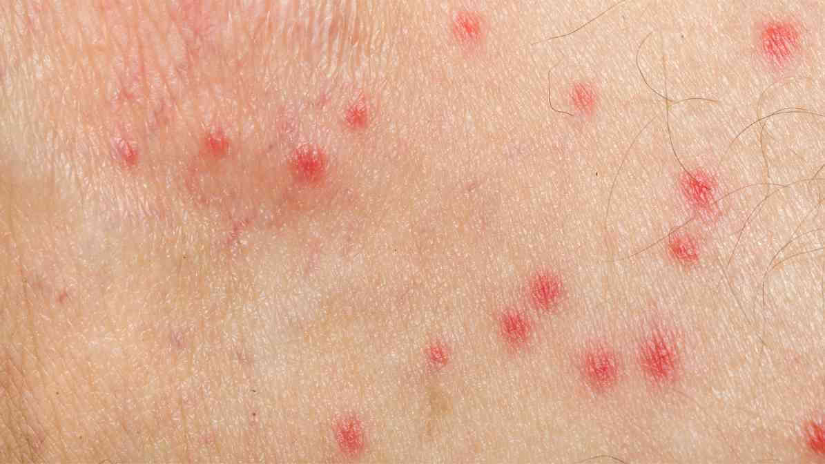 Bed Bug Bite Marks - 1