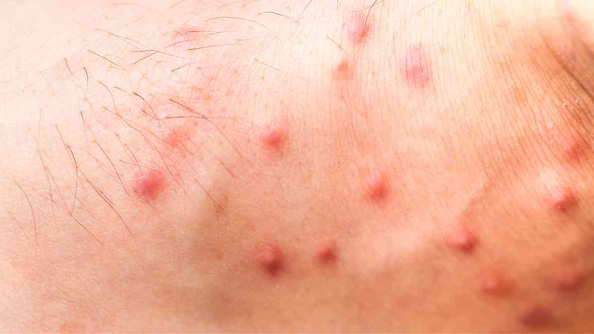 Bed Bug Bite Marks - 3