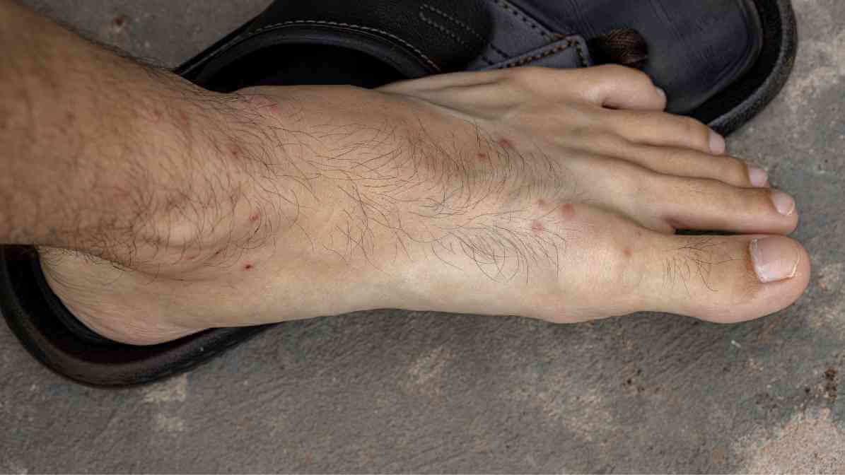 Bed Bug Bite Marks - 4