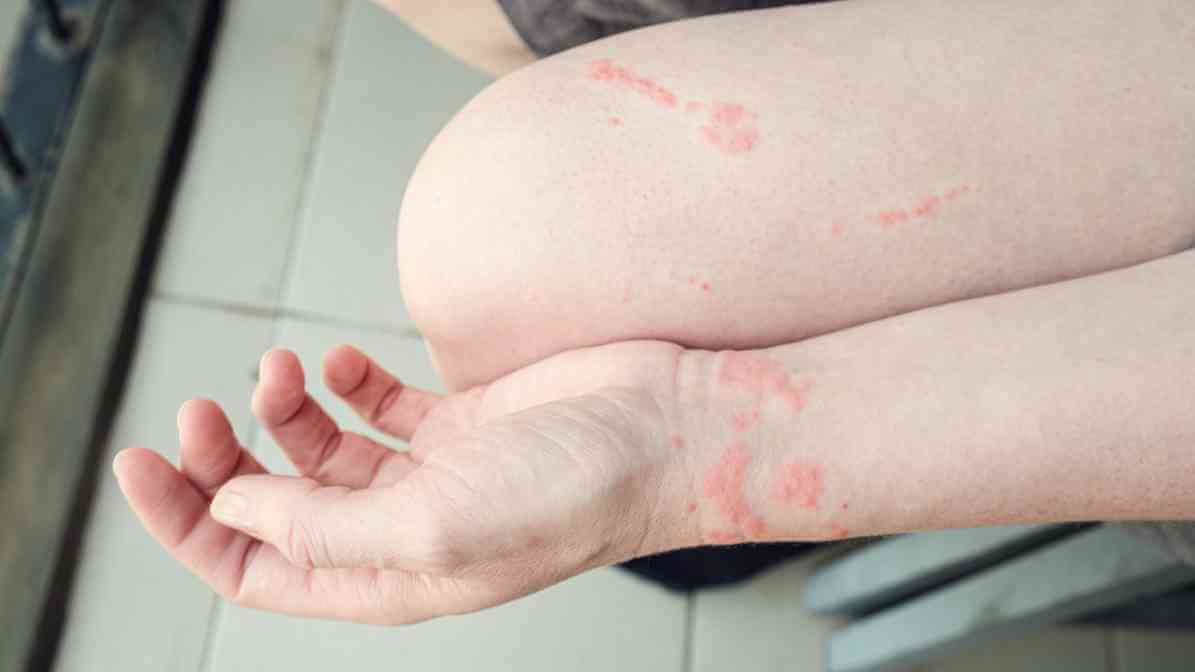 Bed Bug Bite Marks - 5