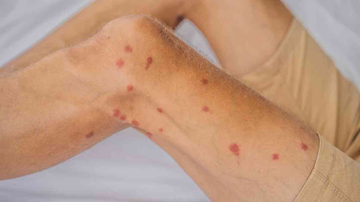 Bed Bug Bite Marks - 6