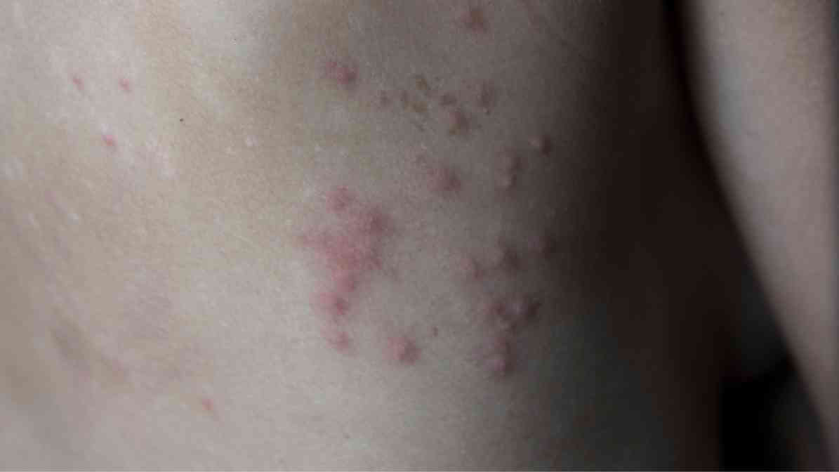 Bed Bug Bites - Physical Evidence