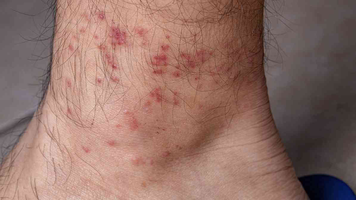 Bed Bug Bites Reactions