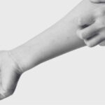 Bed Bug Bites vs Mosquito Bites - Innovative Pest Management MY | Innovative Pest Sdn Bhd Bed Bug Bites vs Mosquito Bites