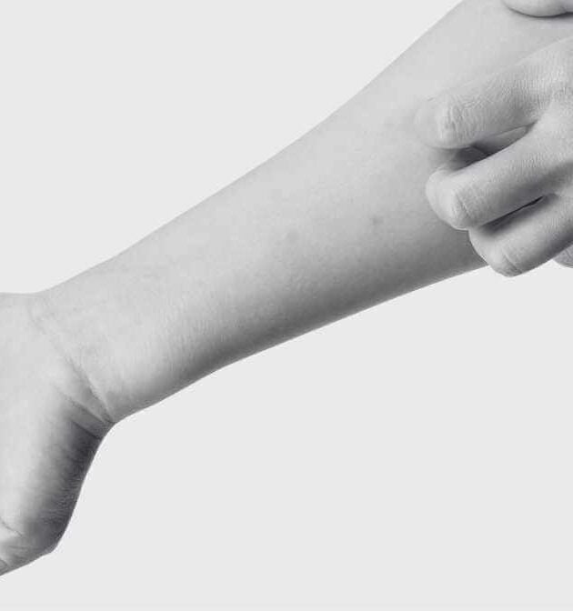 Bed Bug Bites vs Mosquito Bites