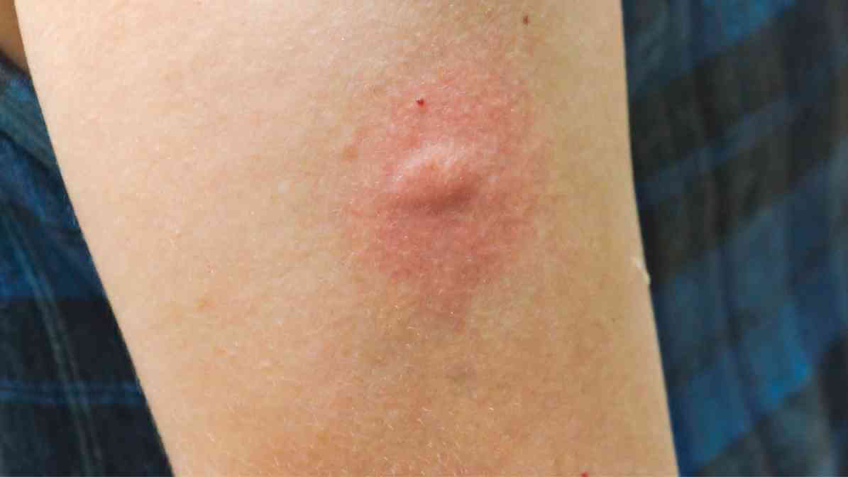 Bed Bug Bites vs Mosquito Bites- Mosquito Bite