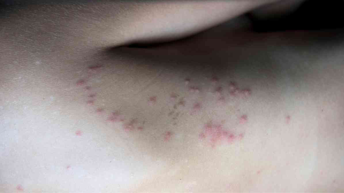 Bed Bug Treatment - Bed Bug Bites