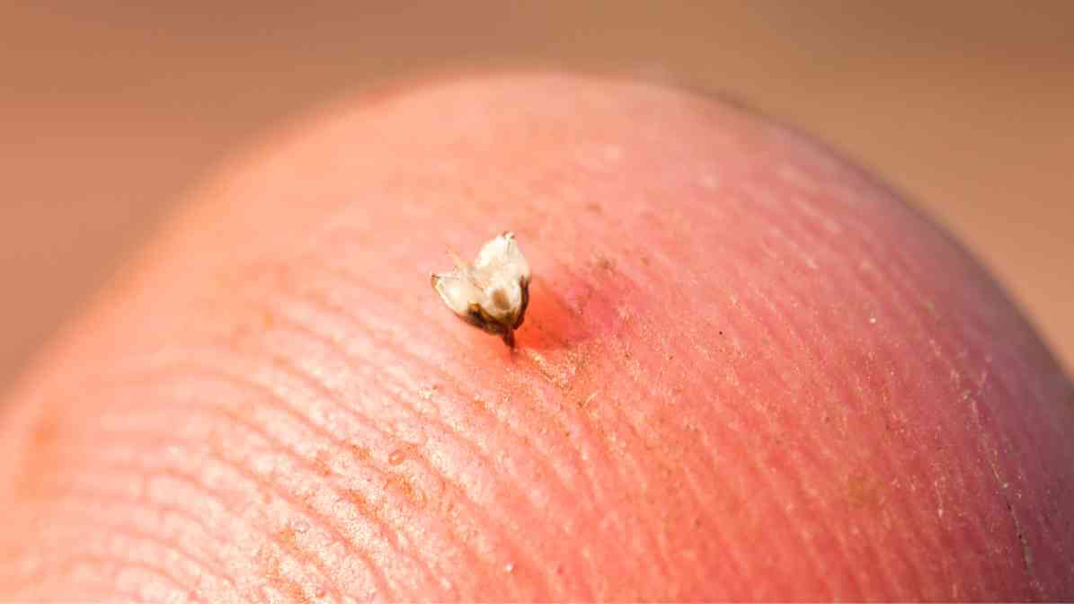 Bee Sting - Stinger Removal | Innovative Pest Sdn Bhd