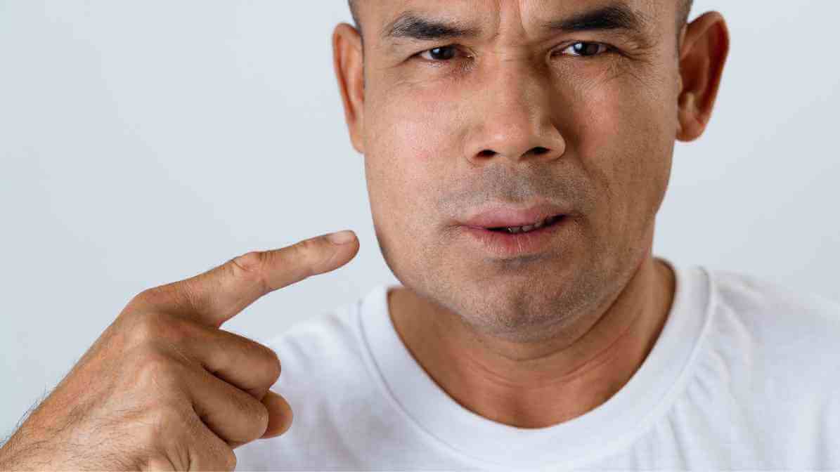 Bee Sting - Swelling | Innovative Pest Sdn Bhd