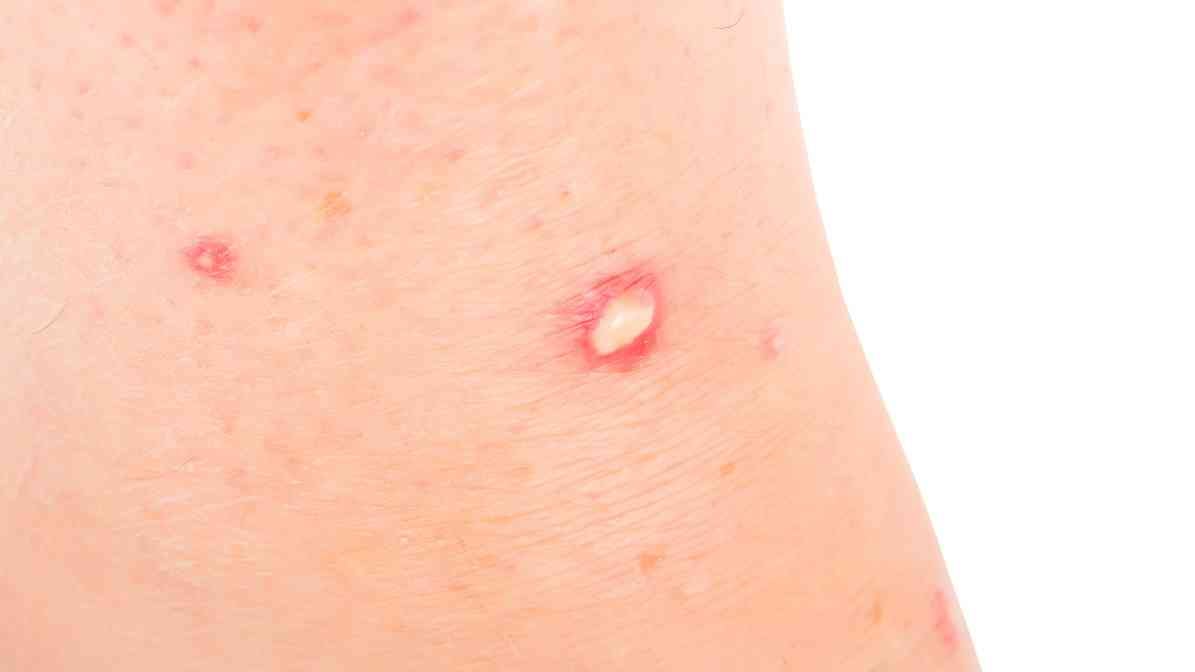 Red Imported Fire Ant Bites