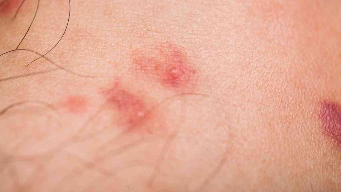 Flea Infestation - Flea Bite Reaction on Human