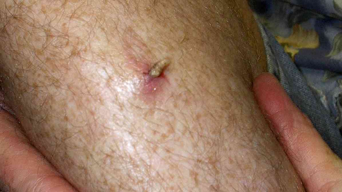 Step 1. Botfly Removal, Swelling
