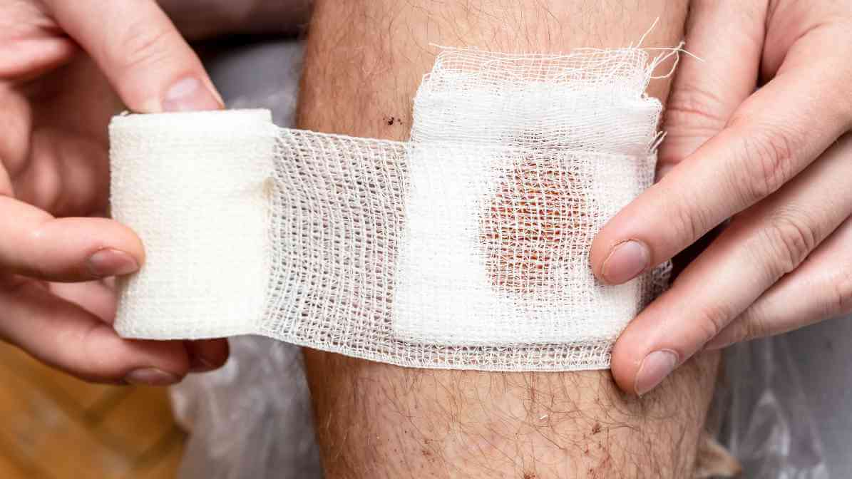Step 5 - Botfly Removal, Clean Wound