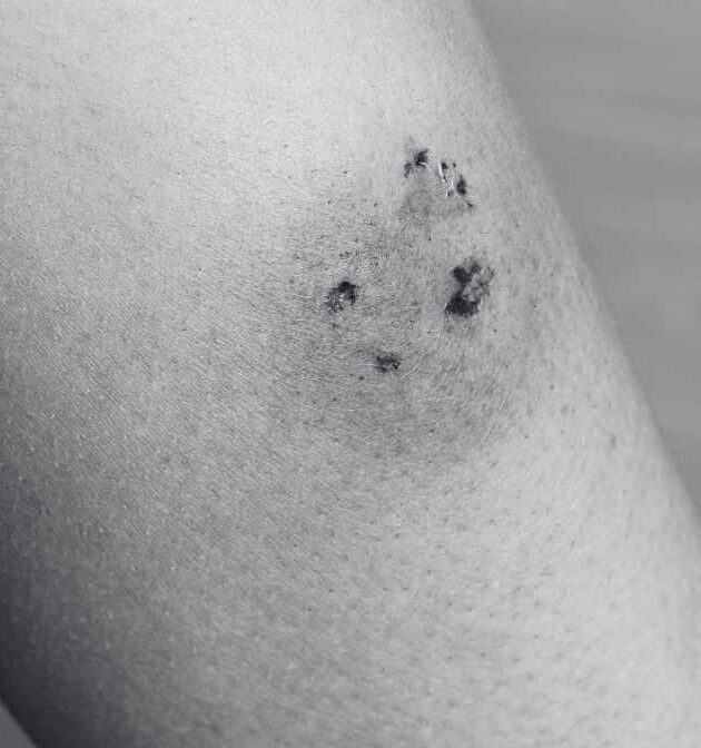 Identifying Spider Bites, Symptoms and Treatment