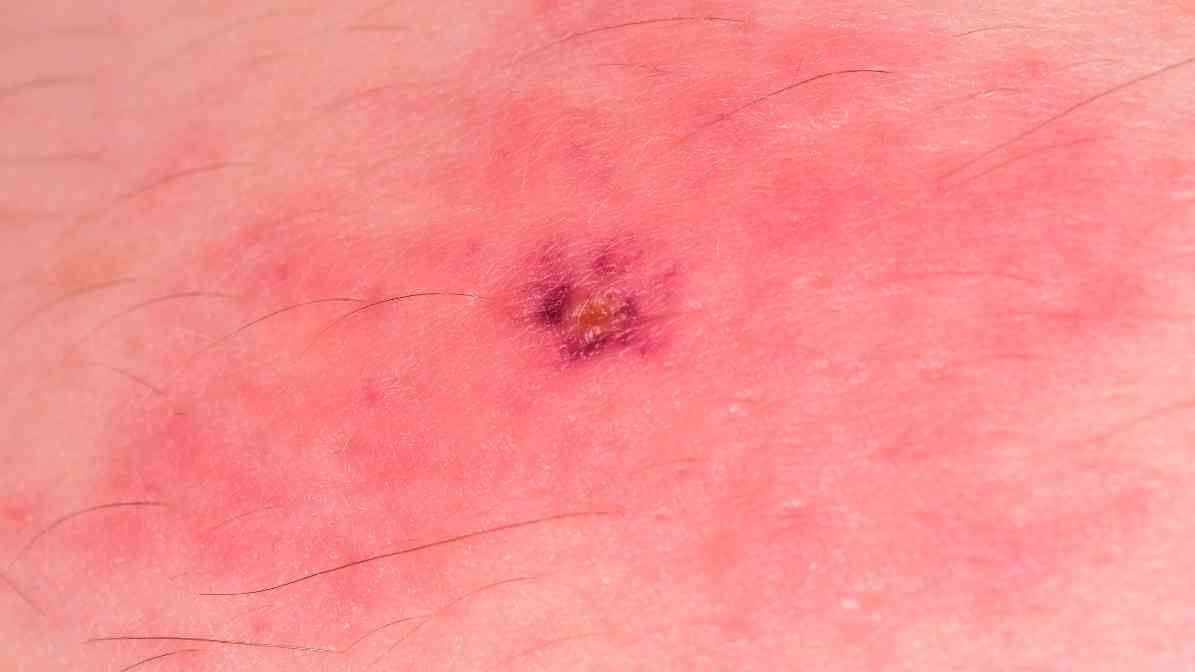 Tick Bite, Swelling and Itching