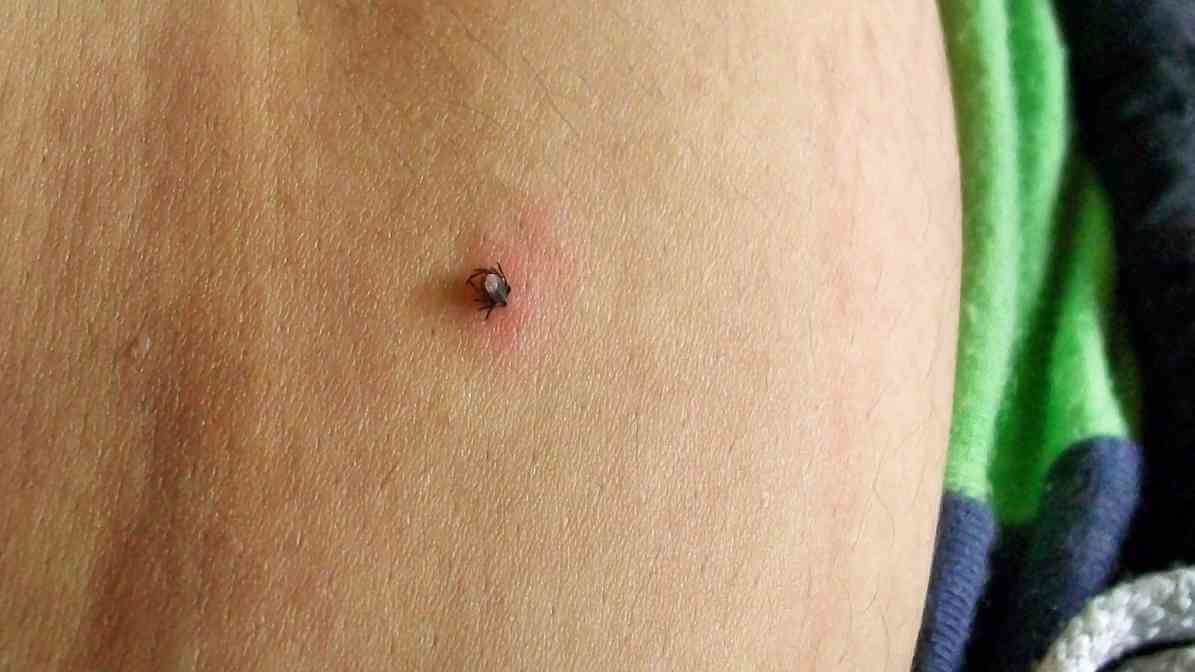 Tick Bite, Tick Hidden in Skin