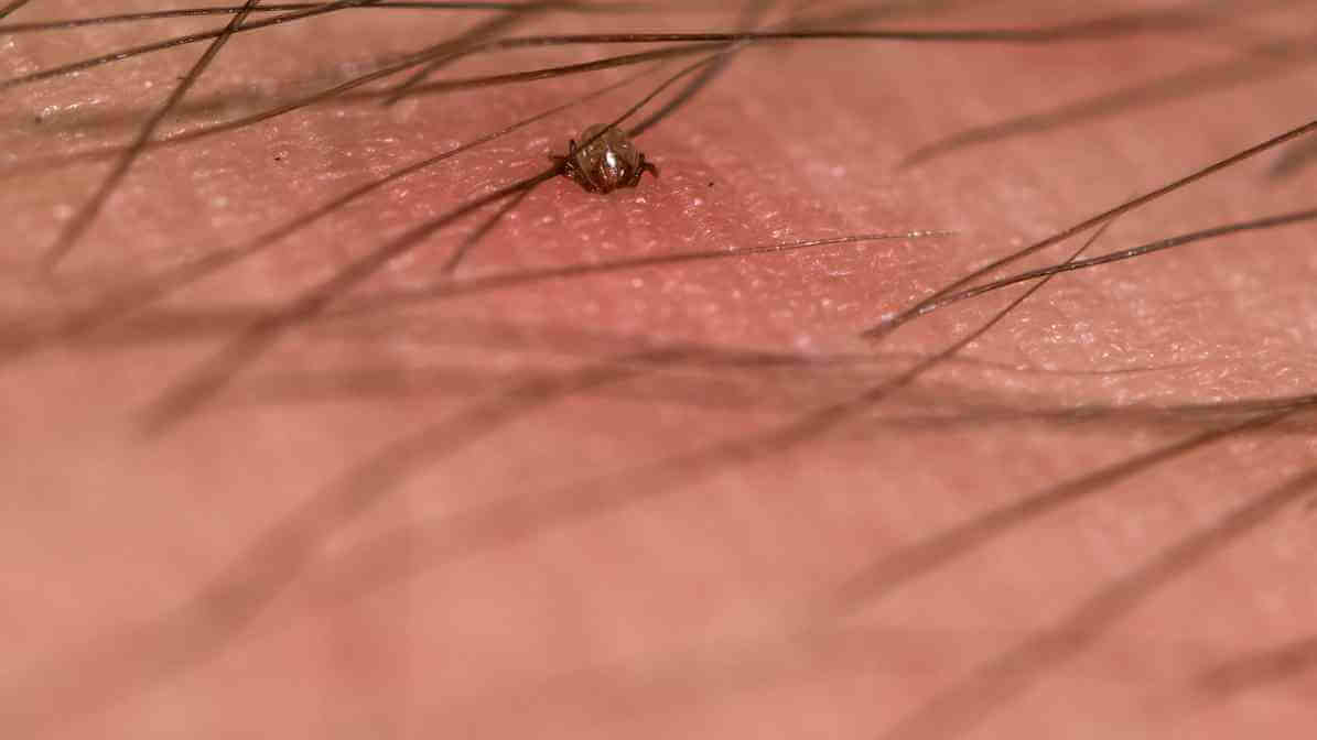 Tick Bite, Tick Remain in Skin