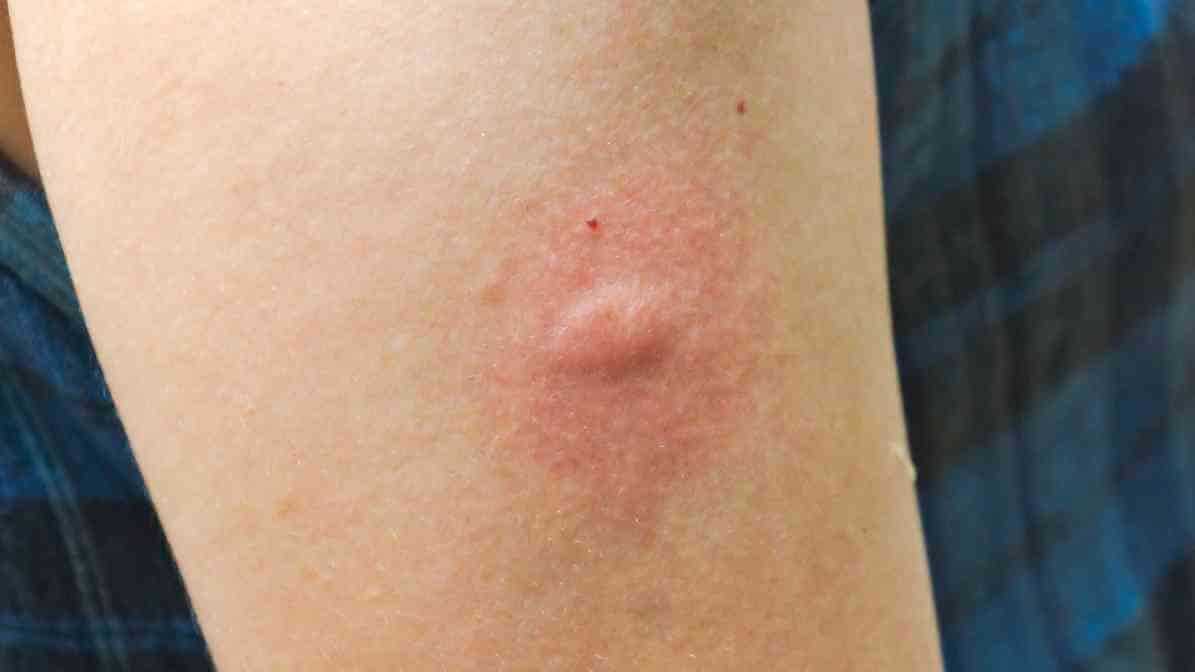 Learn More About Black Ant Bites - Redness and Swelling | Innovative Pest Sdn Bhd Learn More About Black Ant Bites - Redness and Swelling