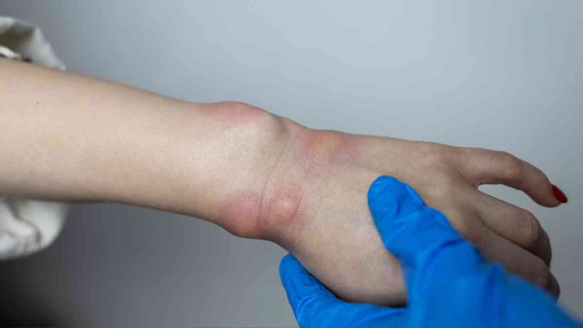 Effective Bees Control in Malaysia - Allergic Reactions